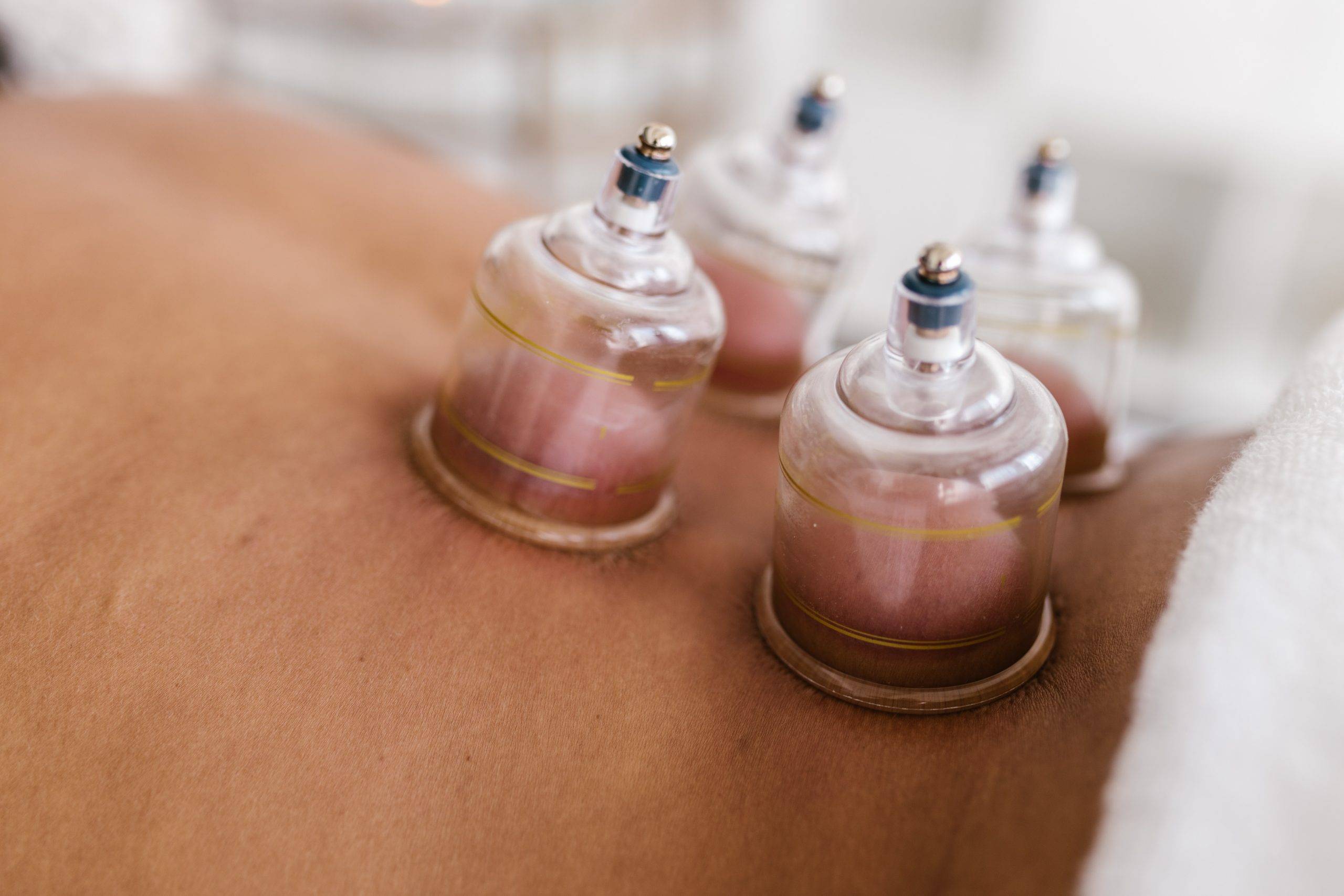 What is Cupping and How Is It Related to Acupuncture?