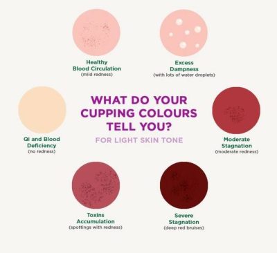 What do the Cupping Marks and Colors Mean?